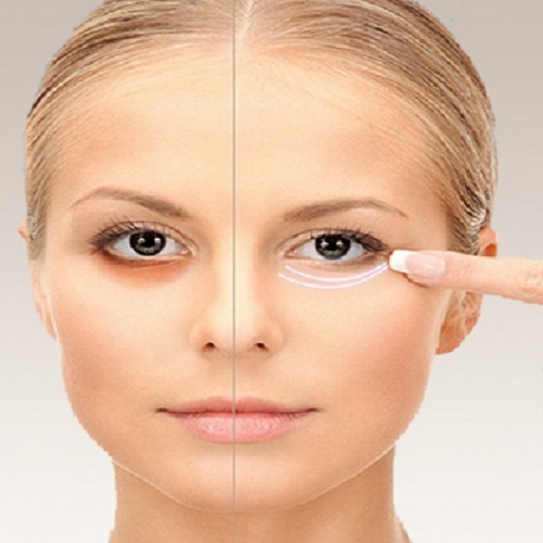 Dark Circles Treatments