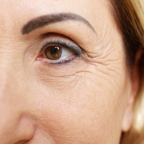 Eye Wrinkles