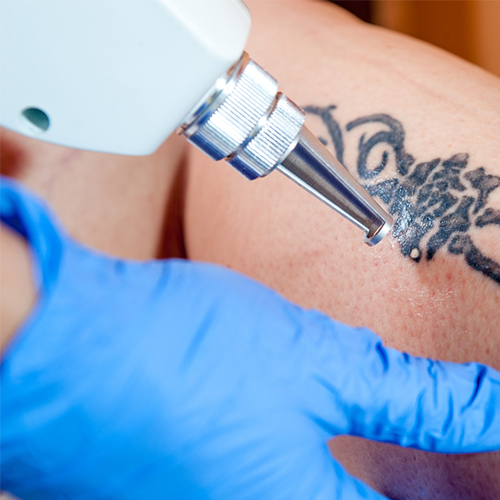 Laser Tattoo Removal