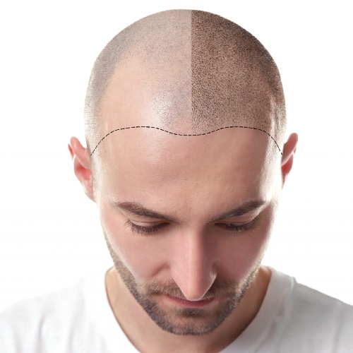 Scalp Micropigmentation